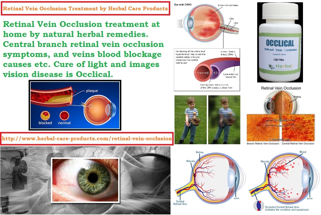 Image result for Natural Treatment for Retinal Vein Occlusion